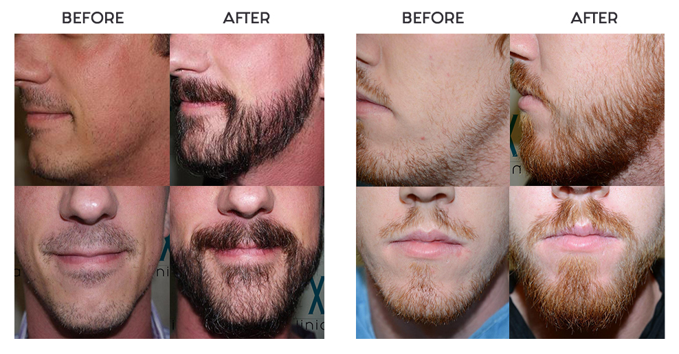 before and after photos beard transplant hair