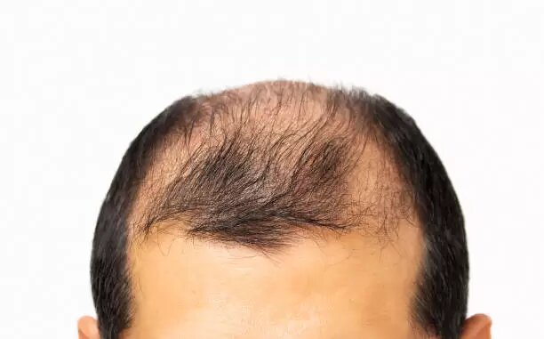 Alopecia androgénica, ¿qué la causa?