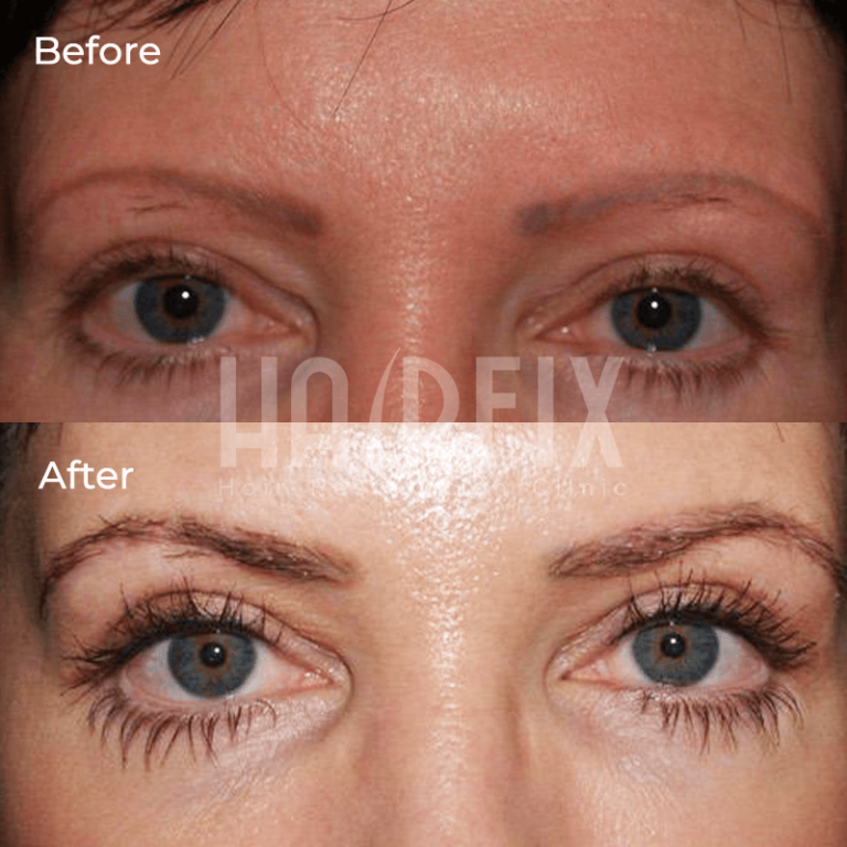 Eyebrow Transplant in Mexico HairFix