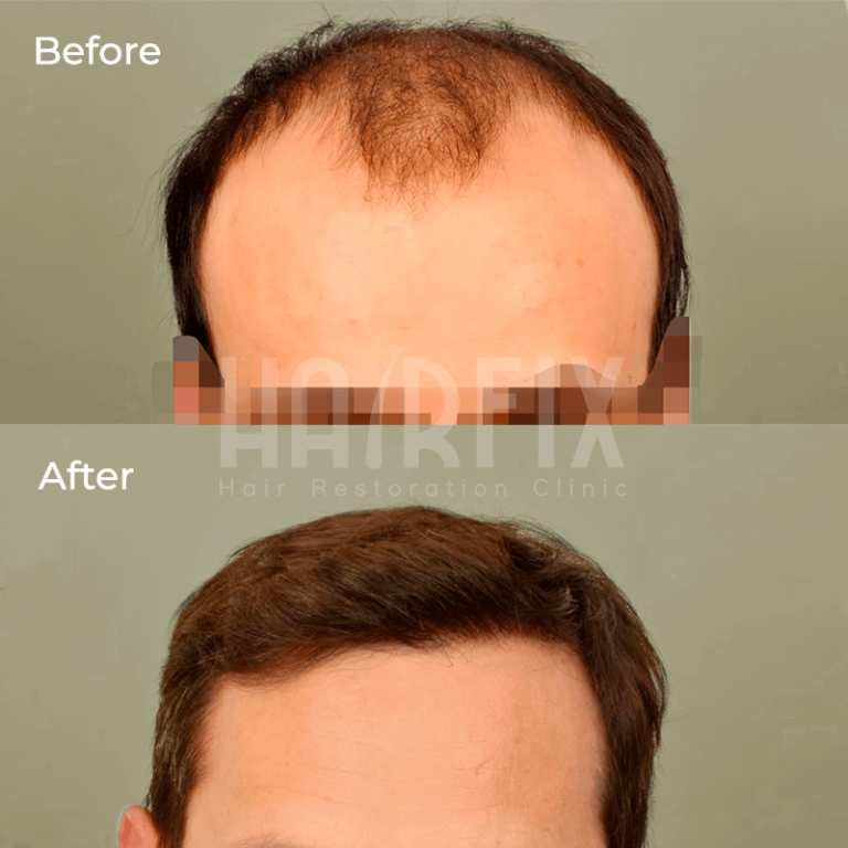 Hair Restoration In Mexico HairFix
