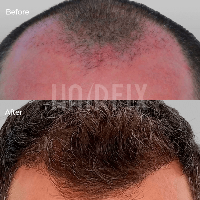 hair restoration_hairfix