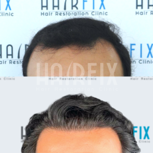Soccer Players With A Hair Transplant | HAIRFIX