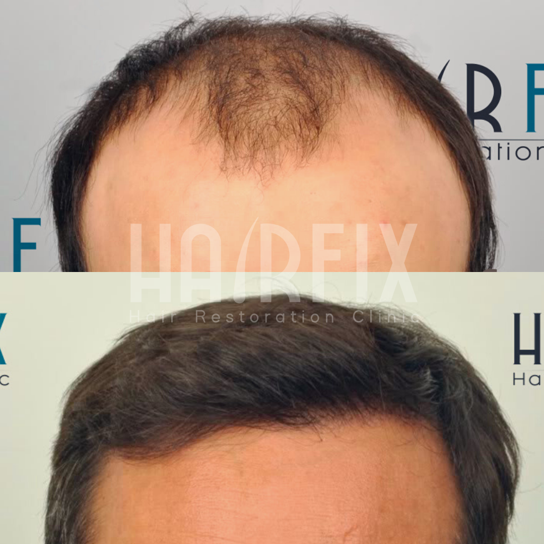 Is A Hair Transplant Permanent? HAIRFIX