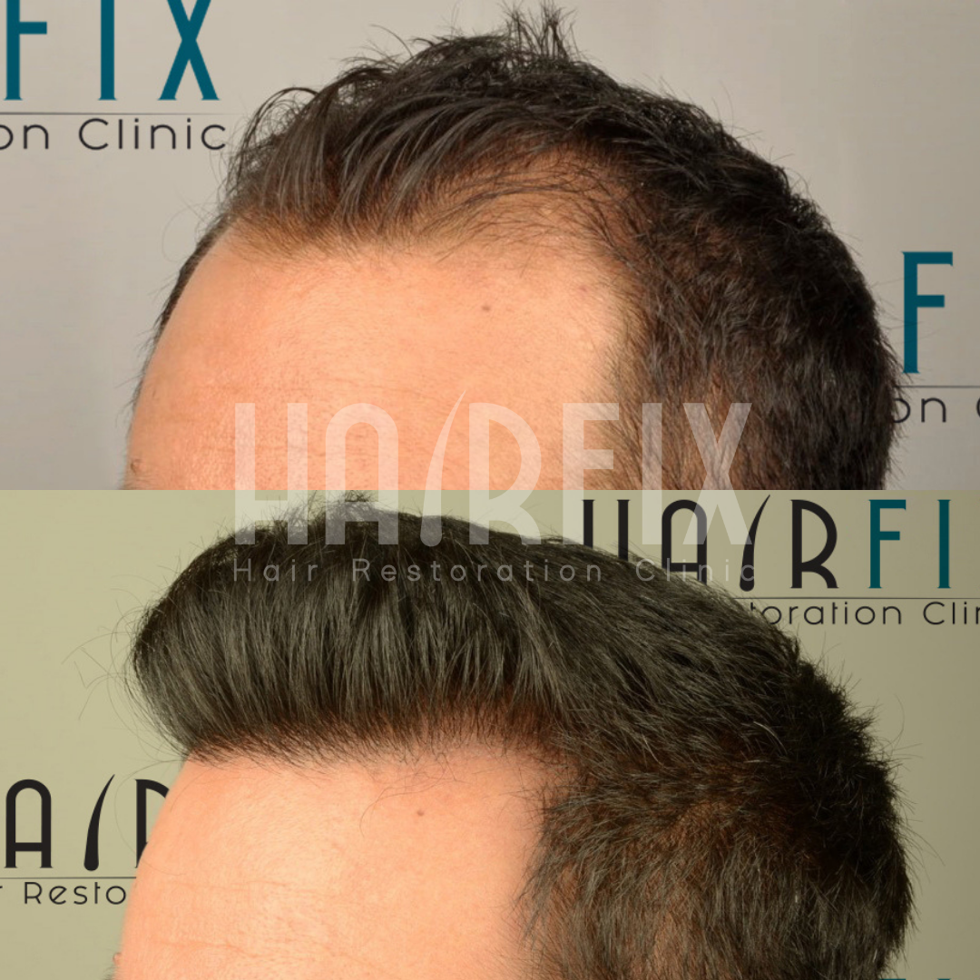 How A Hair Transplant Gives You Natural Results HAIRFIX