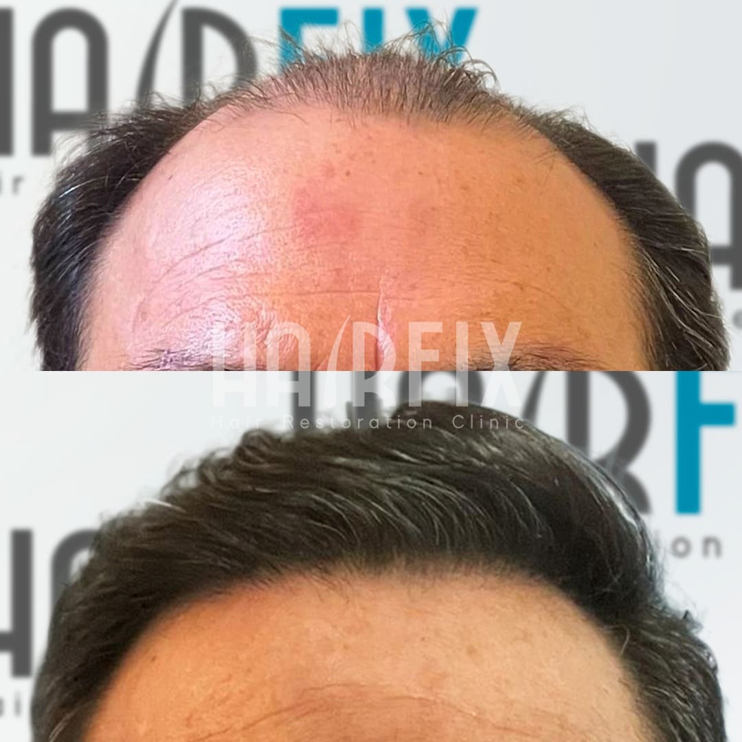 injerto de cabello