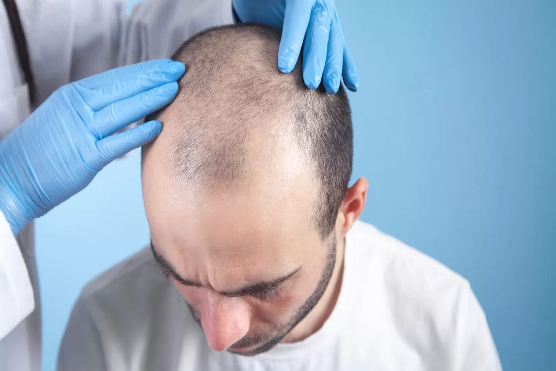 Tasa de éxito y proceso del trasplante de cabello