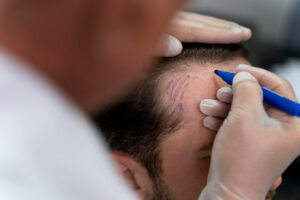 How is a hair transplant performed in a burned area?