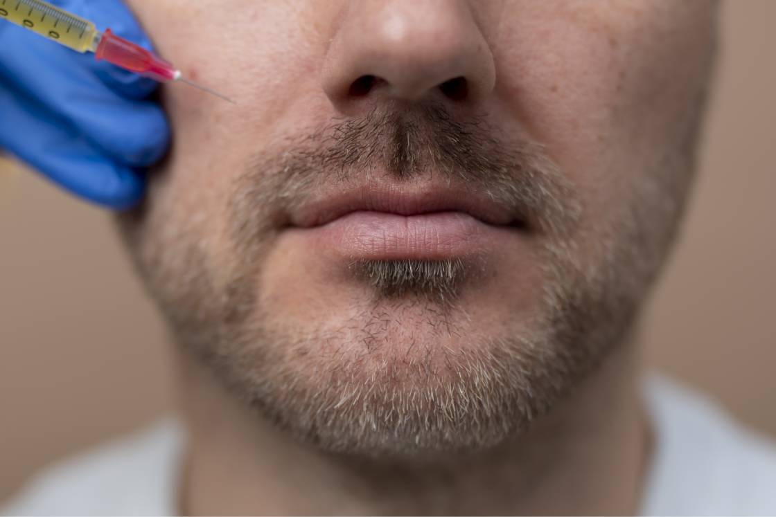 Mustache Hair Transplant