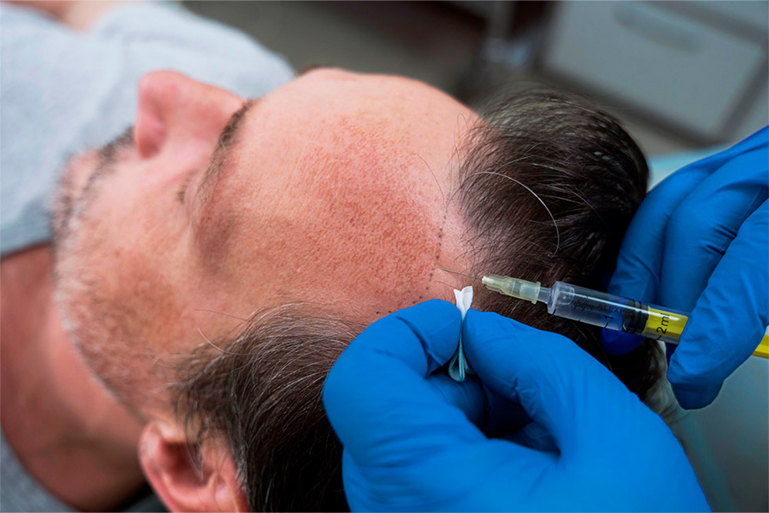 Injerto de cabello rizado vs lacio cuidados posteriores