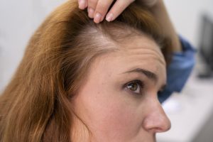 Caída de cabello de un solo lado