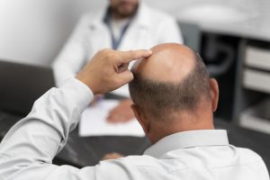 Trasplante de cabello con área donante limitada