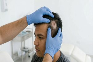 Triangular Alopecia