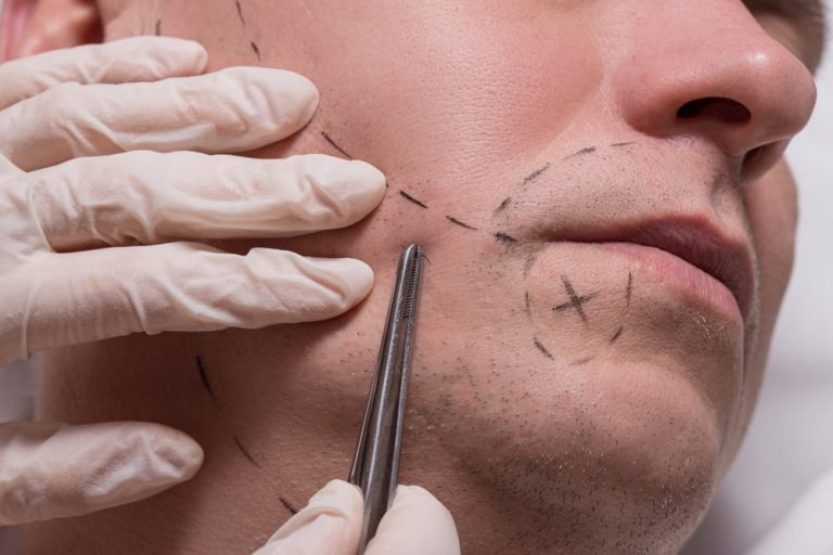 Guía de estructura facial para un exitoso injerto de barba