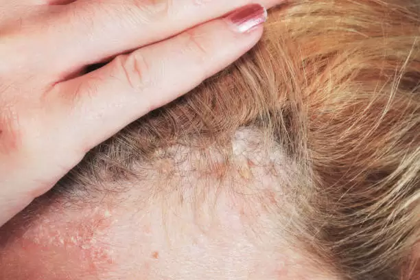causas de la psoriasis