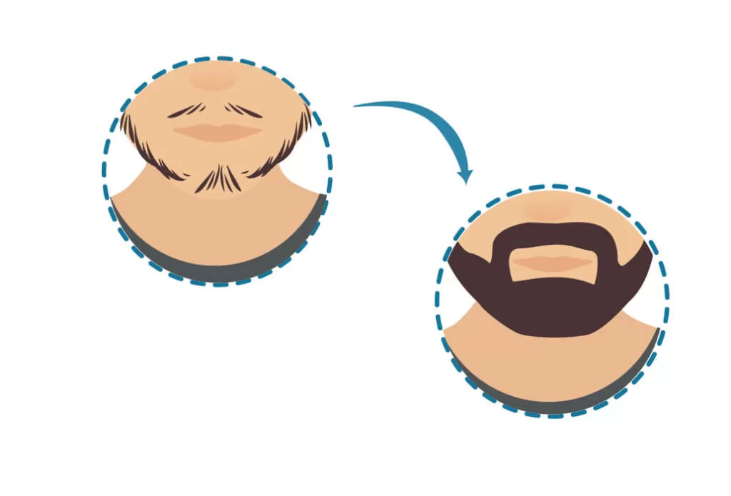 beard restoration
