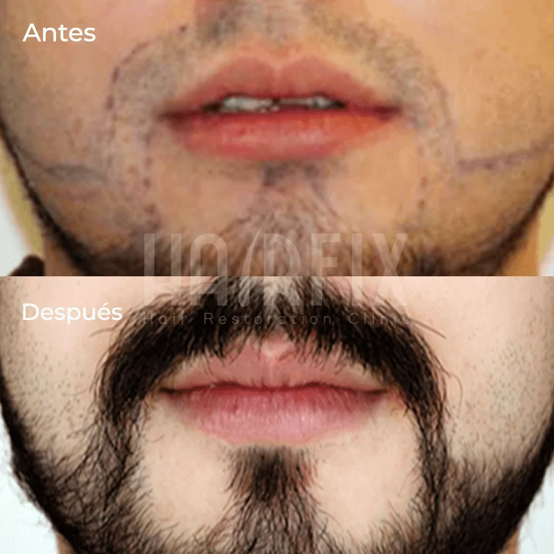 trasplante de barba