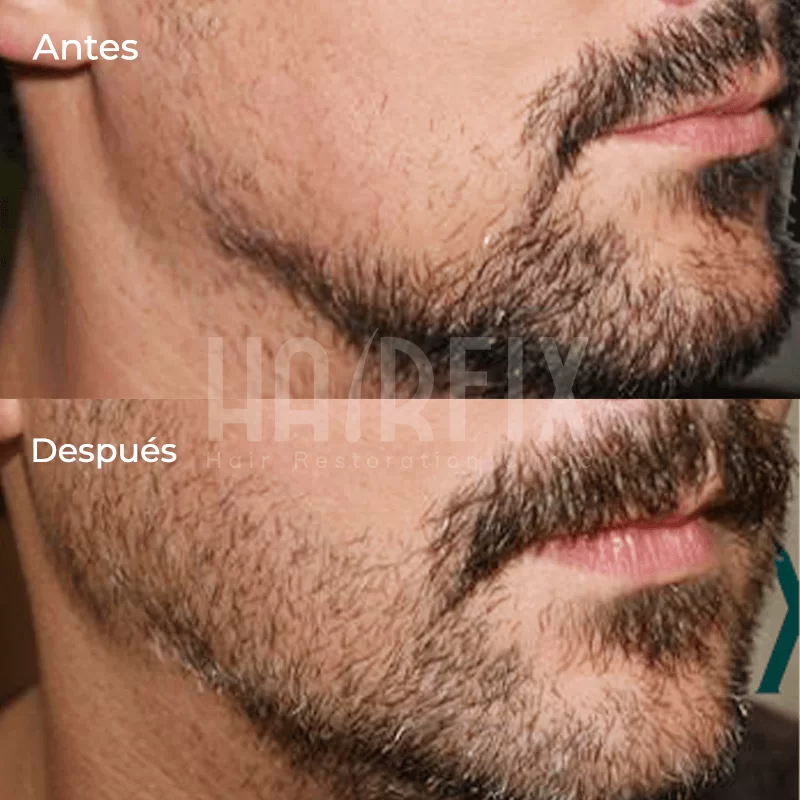 trasplante de barba en México