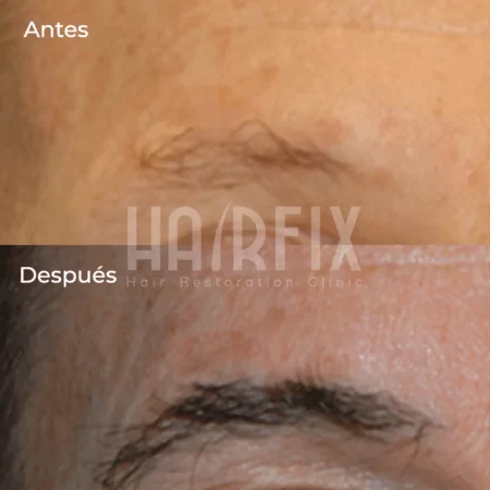 implante capilar de cejas