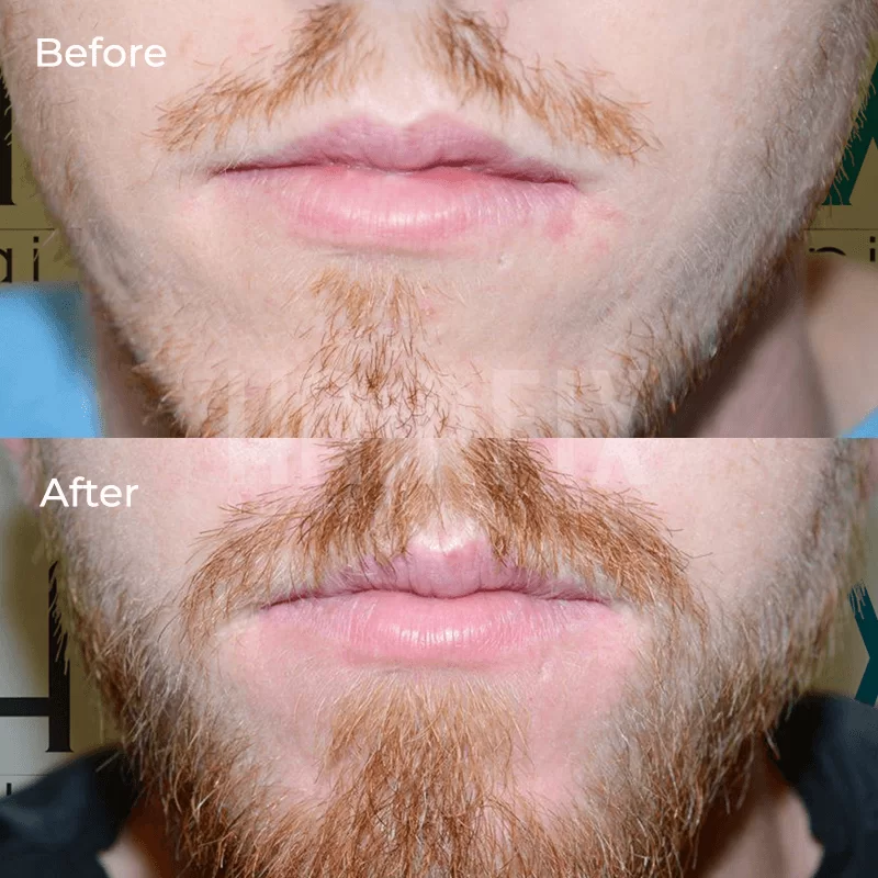 beard implantation in tijuana