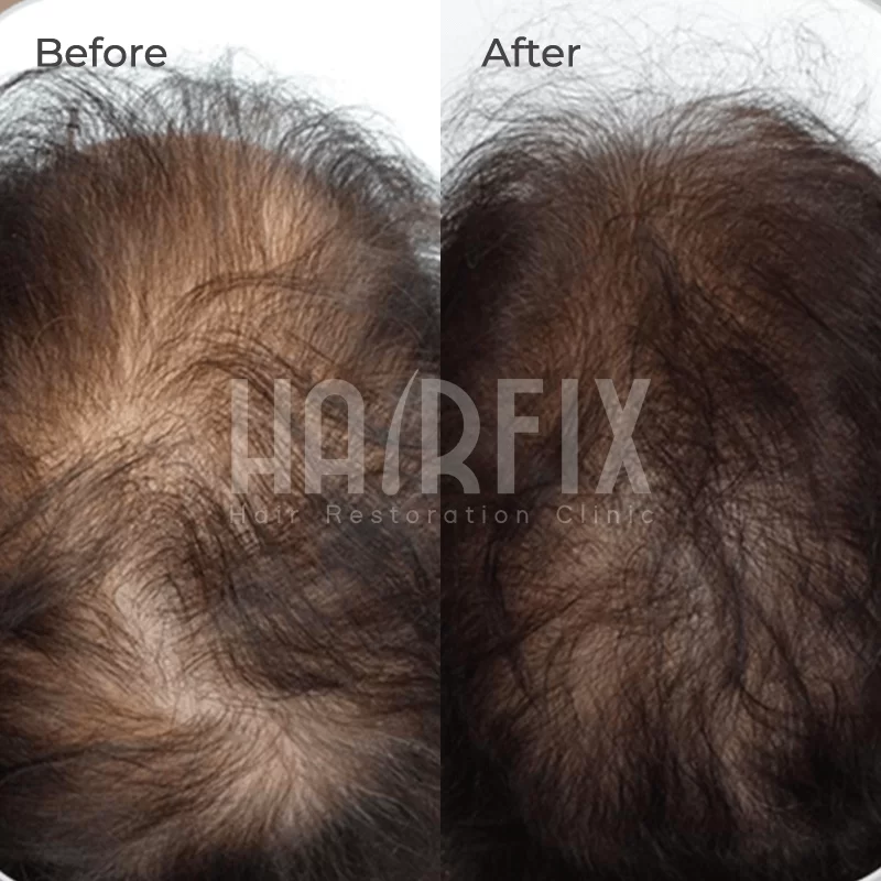 mesotherapy for hair loss in mexico
