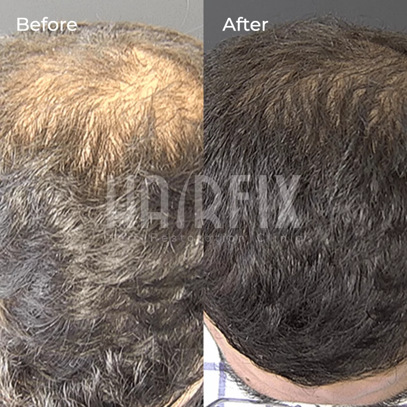 mesotherapy for hair loss in tijuana