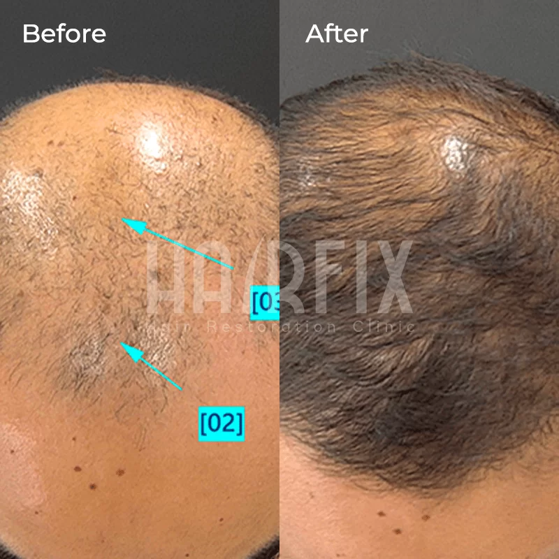 mesotherapy for hair loss in tijuana_Mesotherapy with Dutasteride