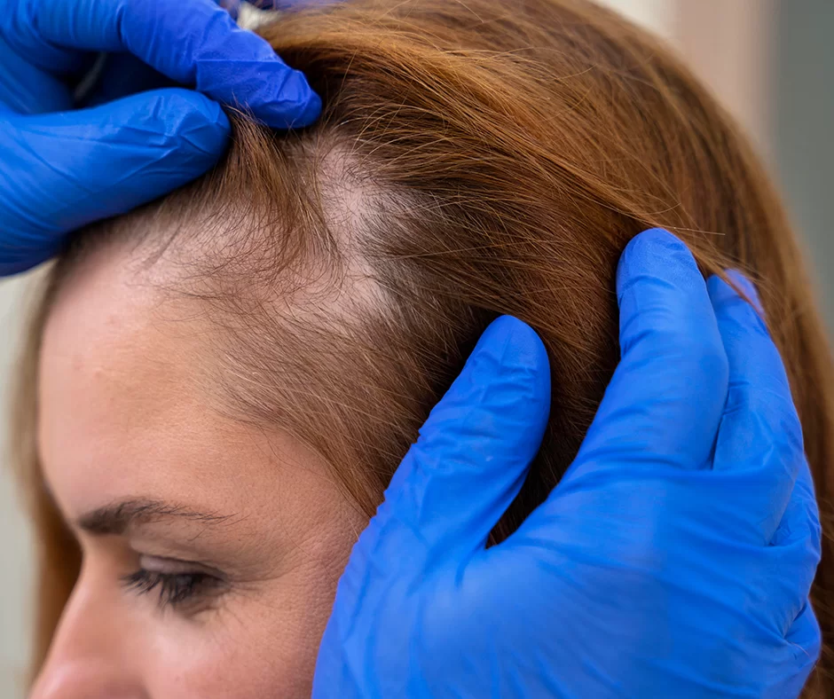 Women hair transplant: causes of alopecia in women - Hairfix