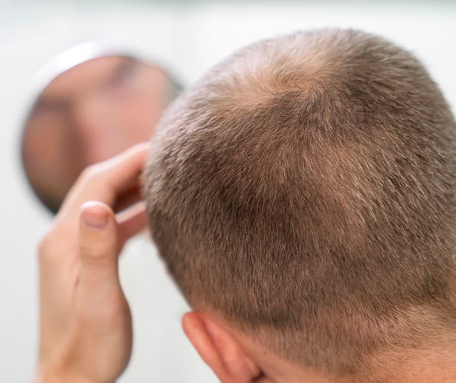 Most effective Hair Loss Treatment in Mexico | HairFix