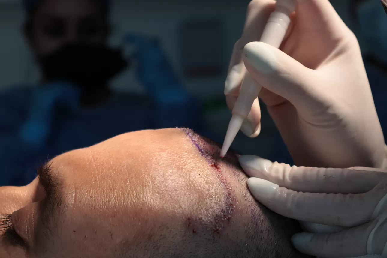 hair graft procedure