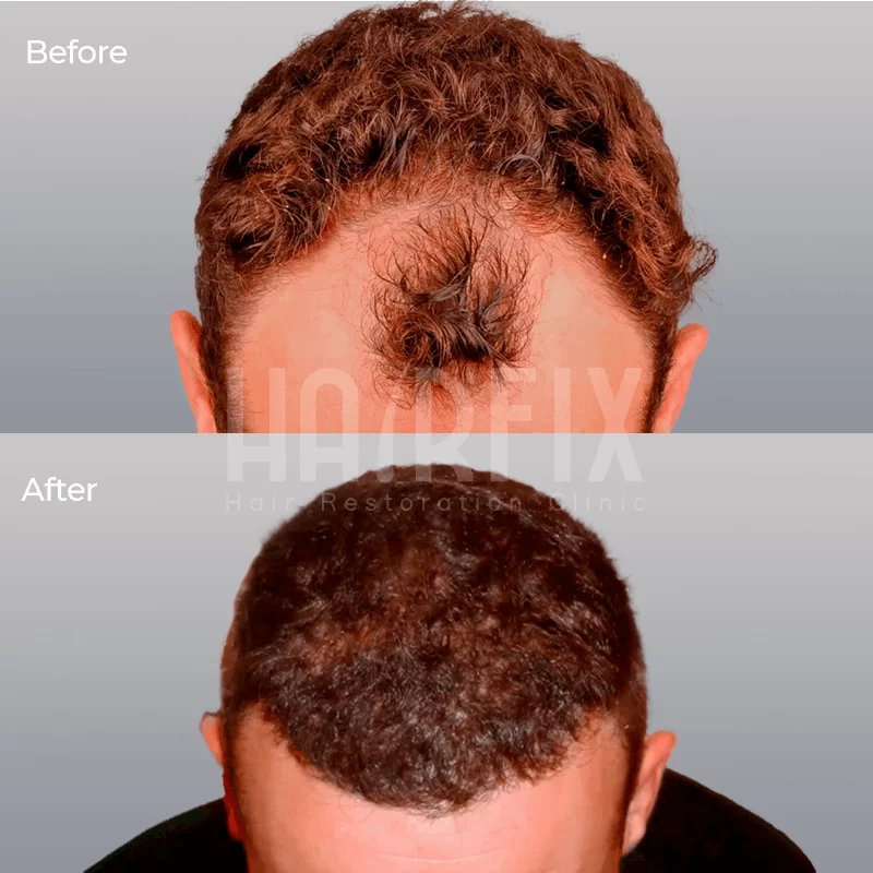 hair implantation in Mexico