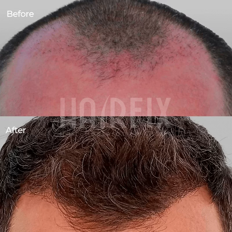 hair restoration cost in Mexico