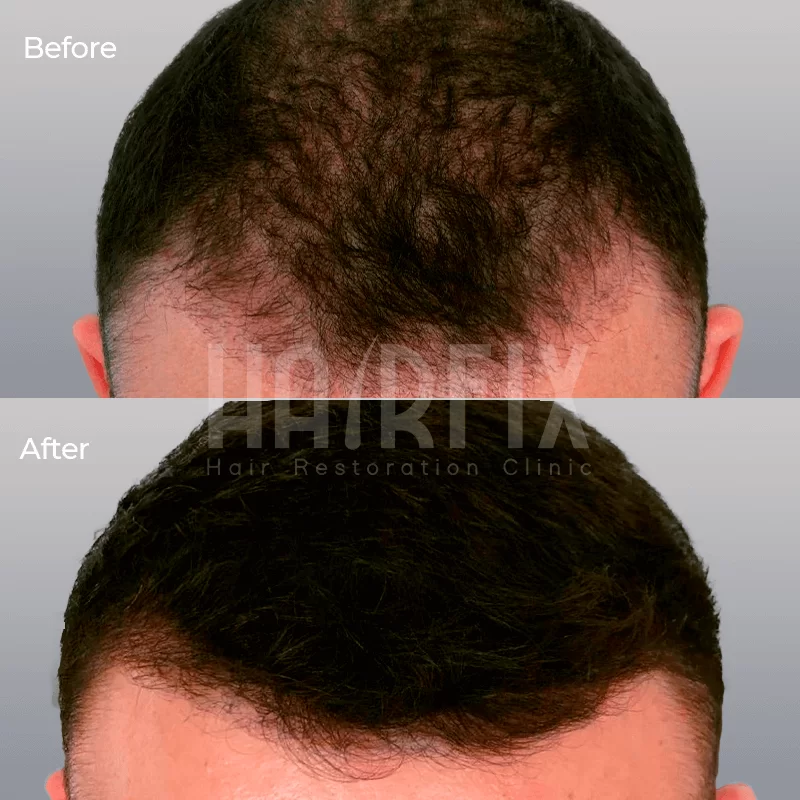 hair implantation in tijuana