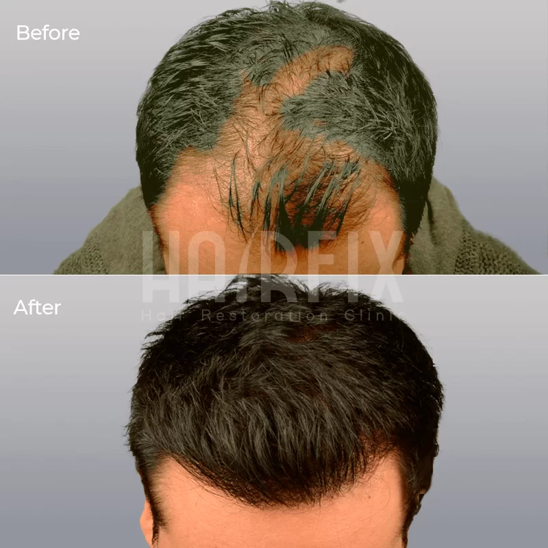hair restoration in mexico