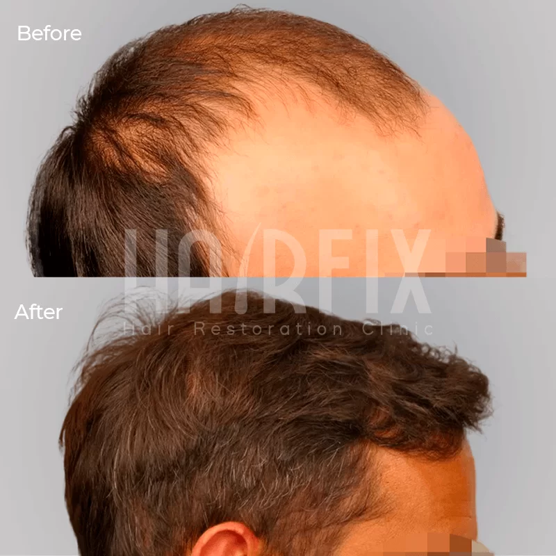 Hair transplant