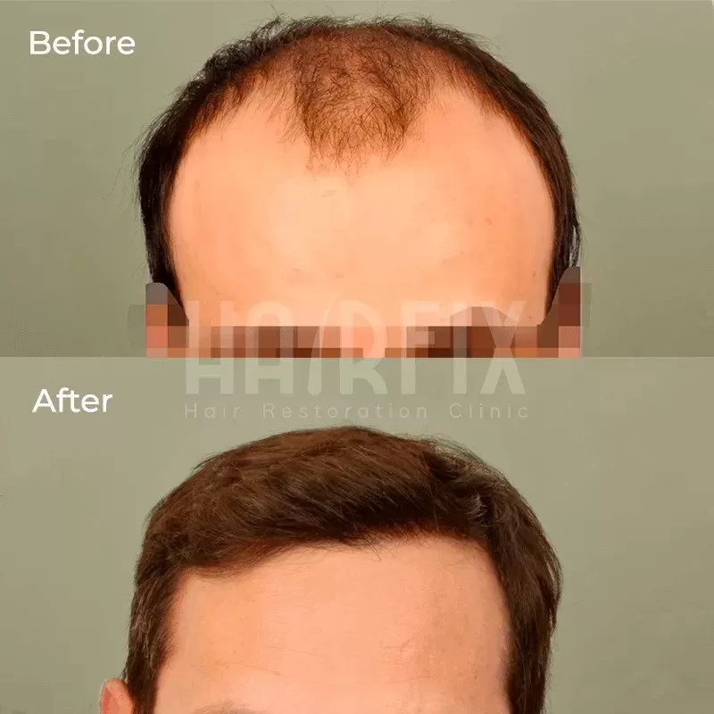 Trasplante capilar Antes y después