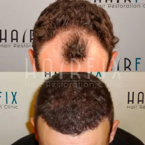 Hair Transplant Results