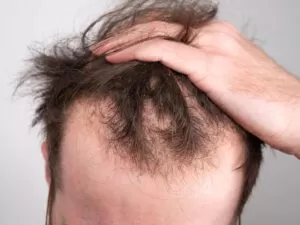 How Hair Loss Affects Men´s Mental Health - Hairfix