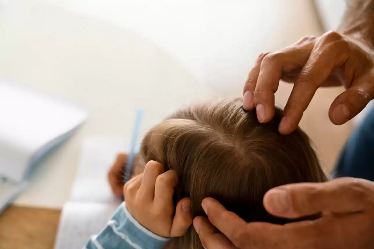 Causas de la alopecia infantil / causes of alopecia in children