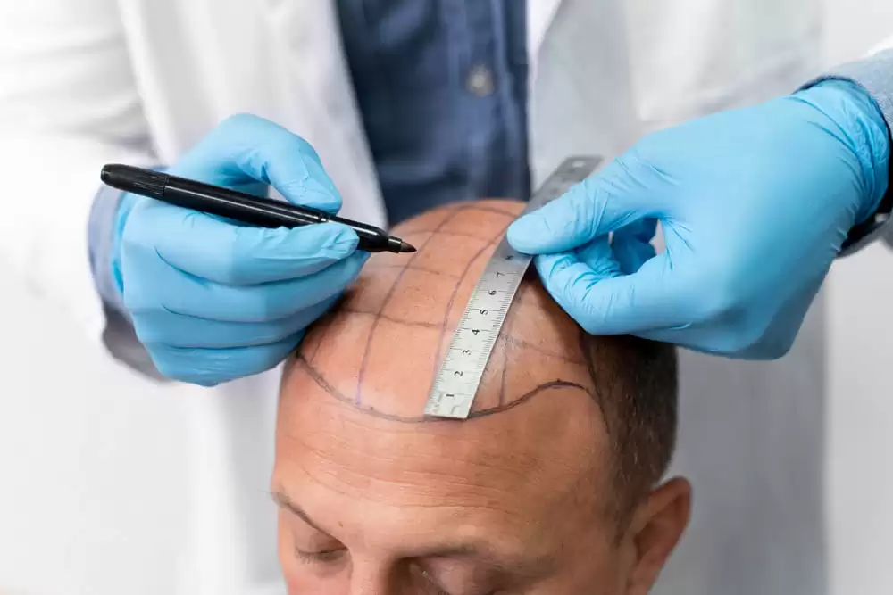 How to Find the Best Hair Transplant Surgeons, top hair transplant clinic  2022 London Harley street