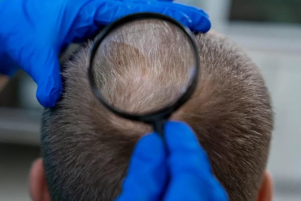 How to Lighten the Impact of Baldness?