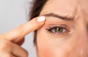 Alopecia from Excessive Plucking